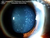 Congenital Blue Dot Cataract
